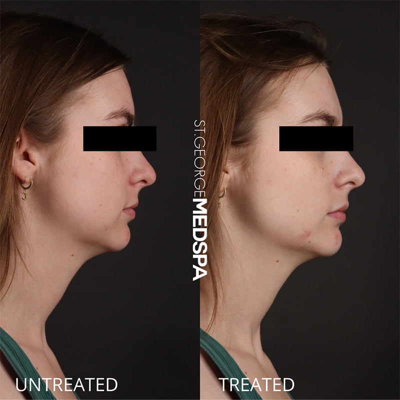 St. George Med Spa cheek filler after — St. George, UT