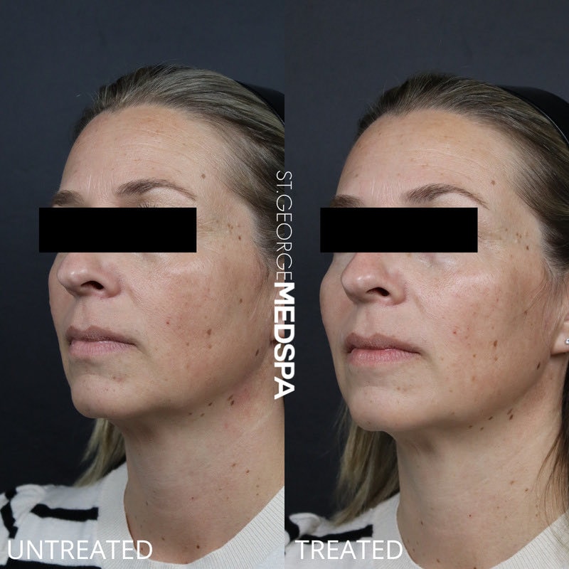 A result from St. George Med Spa