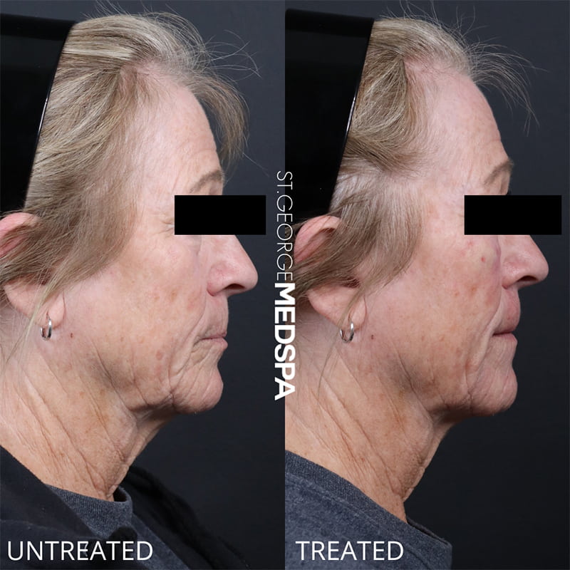 St. George Med Spa cheek filler after — St. George, UT