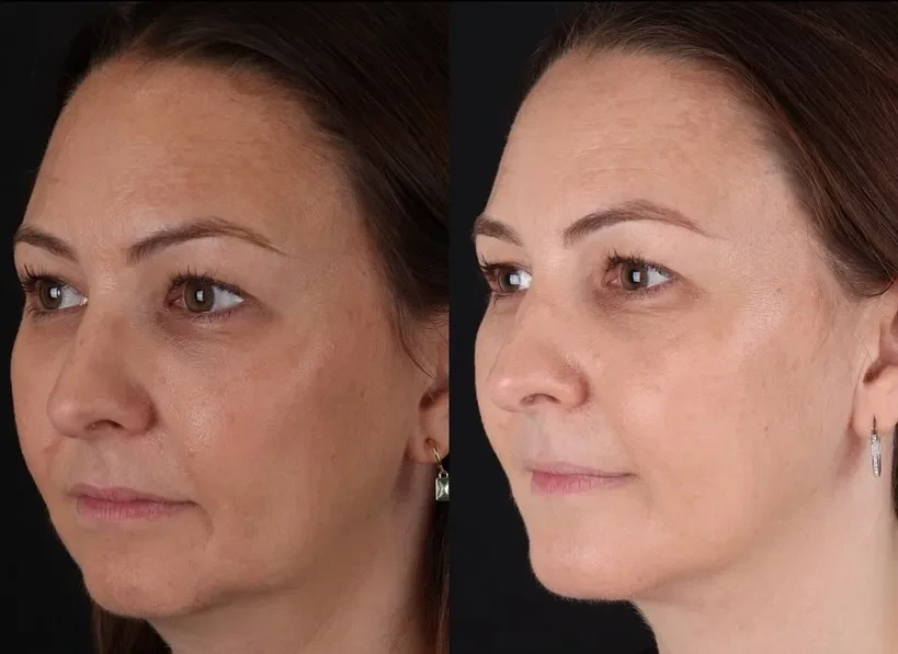 A result from John M. Shamoun, M.D. FACS - Newport Beach Plastic Surgery