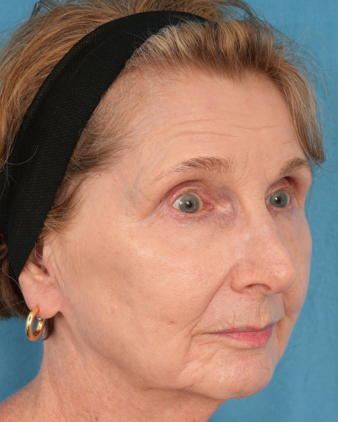 A result from Facial Plastic Surgeon Winnetka: Dr. Paul Phelps
