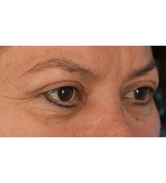 A result from Facial Plastic Surgeon Winnetka: Dr. Paul Phelps