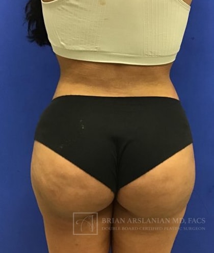 A result from Arslanian Plastic Surgery: Dr. Brian Arslanian