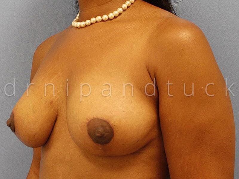 A result from Dr. Nip and Tuck (Plastic Surgery Inst)