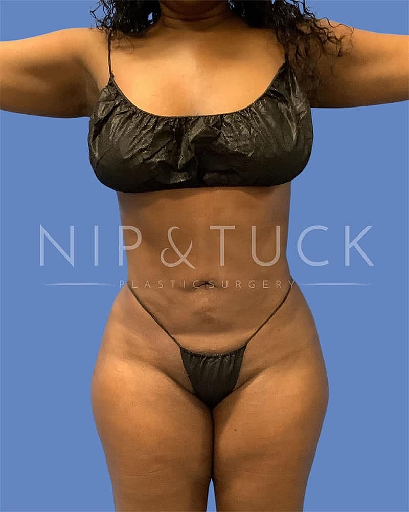 A result from Dr. Nip and Tuck (Plastic Surgery Inst)