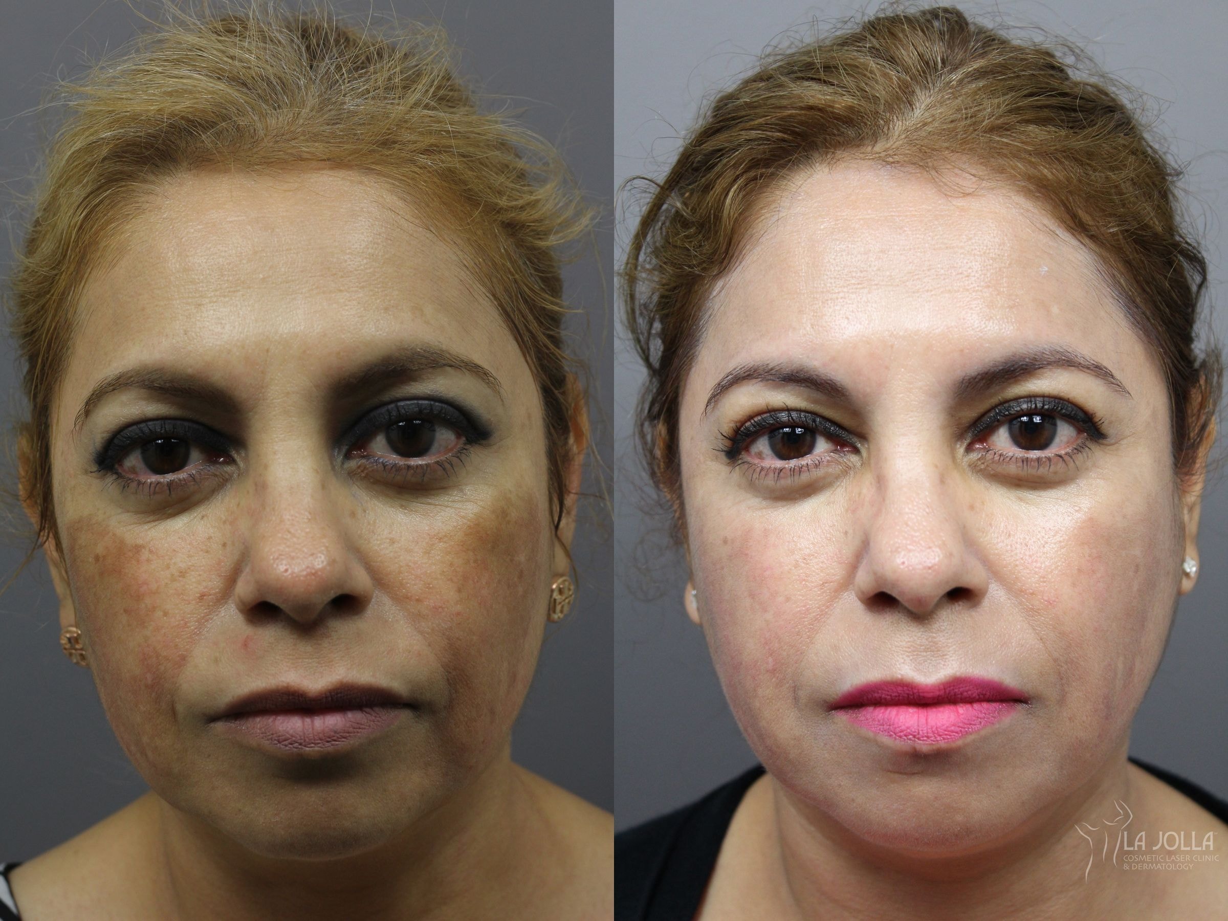 A result from La Jolla Cosmetic Laser Clinic & Dermatology
