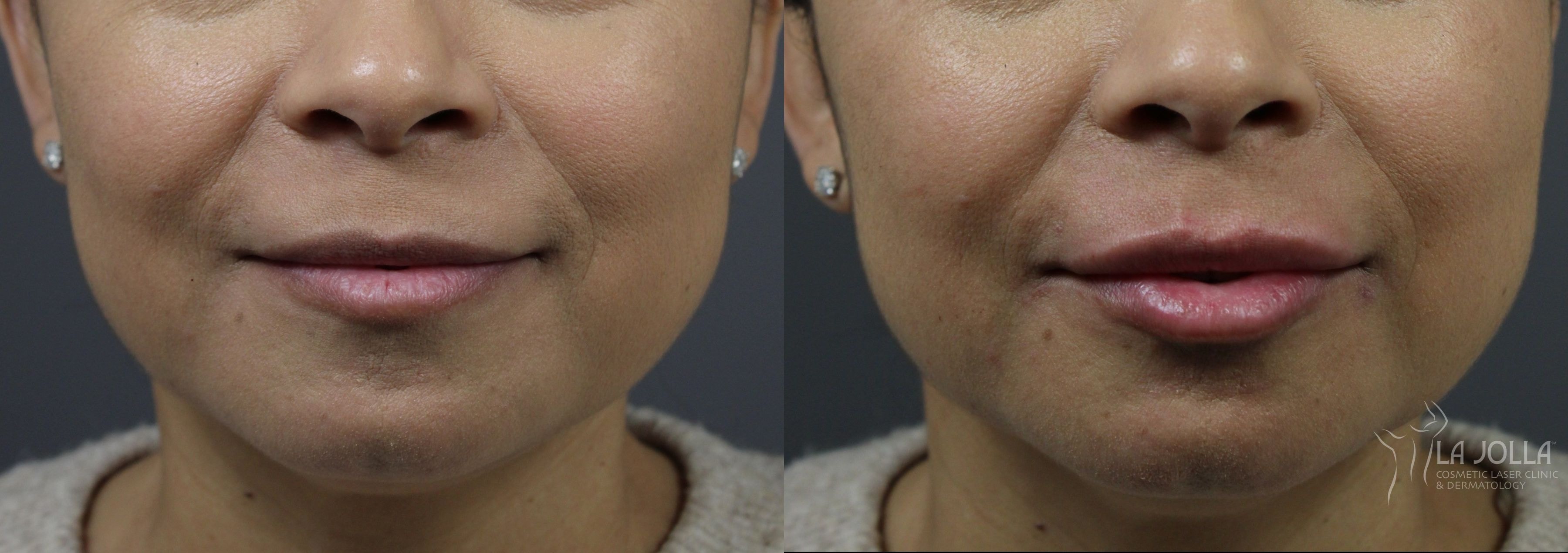 A result from La Jolla Cosmetic Laser Clinic & Dermatology