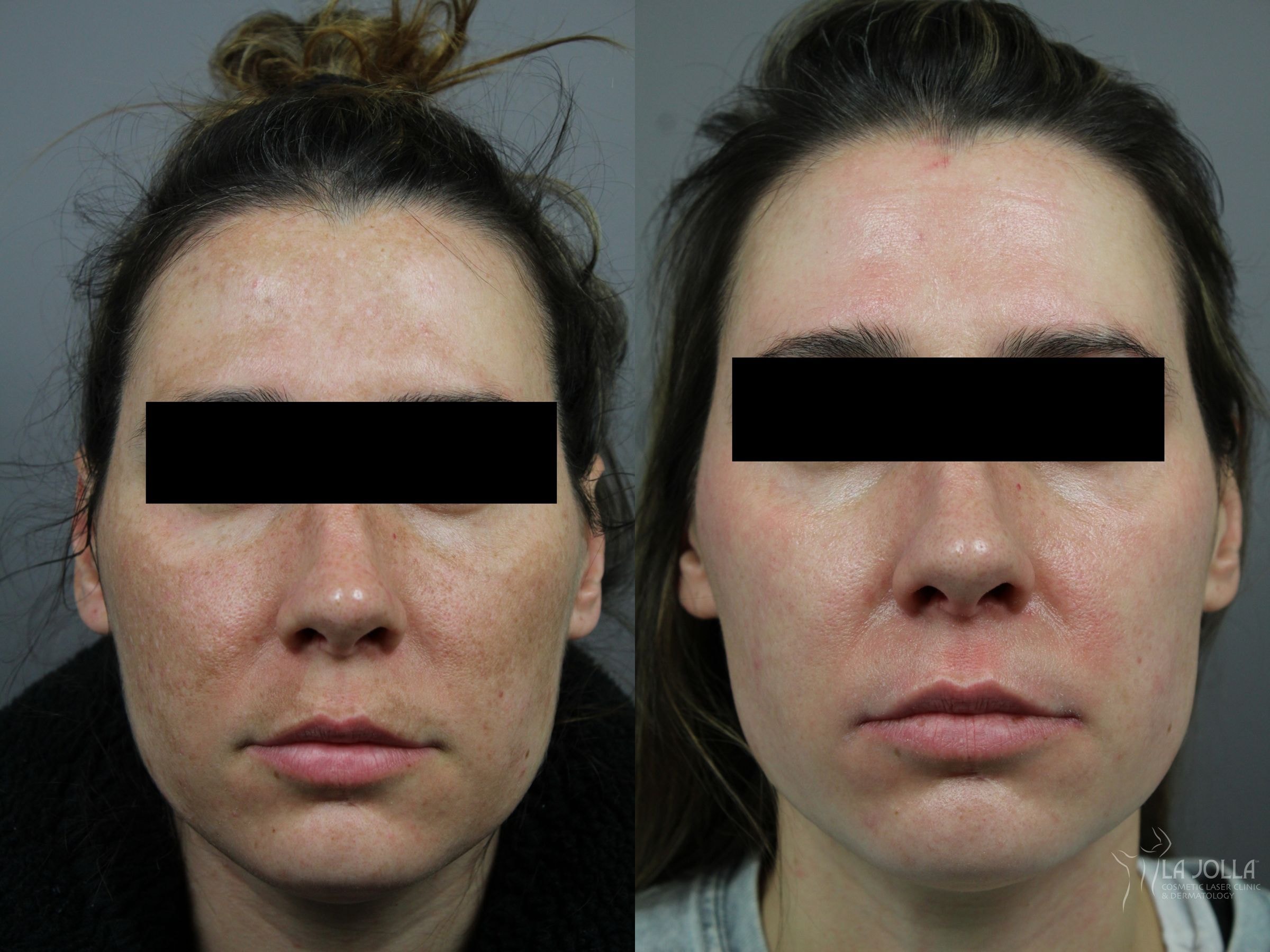 A result from La Jolla Cosmetic Laser Clinic & Dermatology