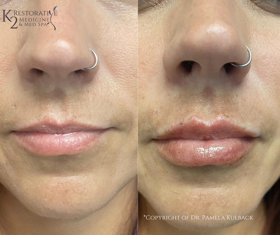 A result from K2 Restorative Medicine & Med-Spa