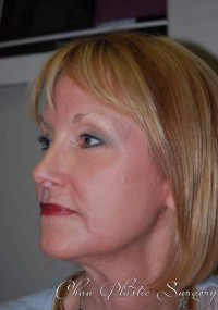 A result from Chau Plastic Surgery