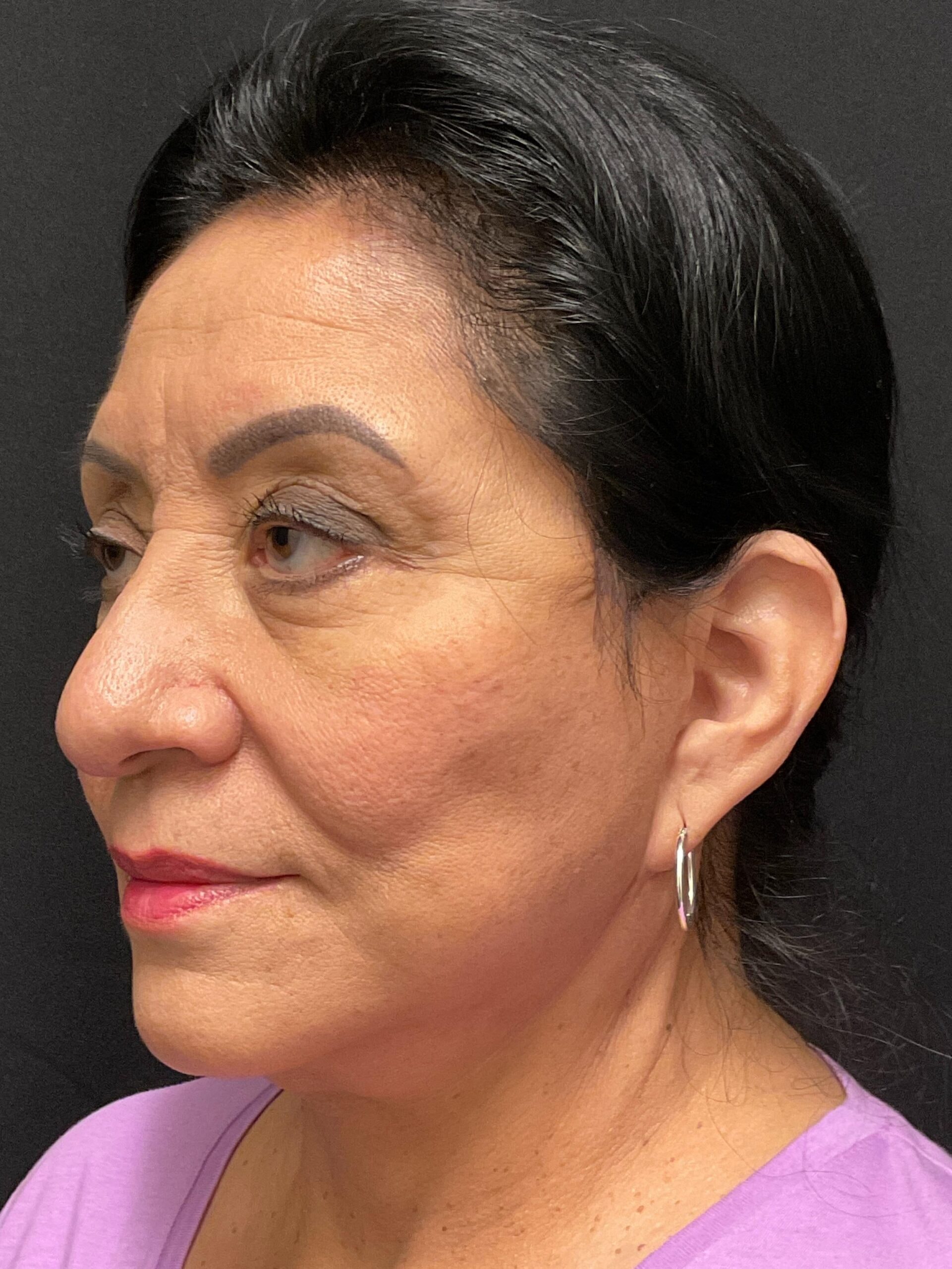 A result from Snyder Plastic Surgery