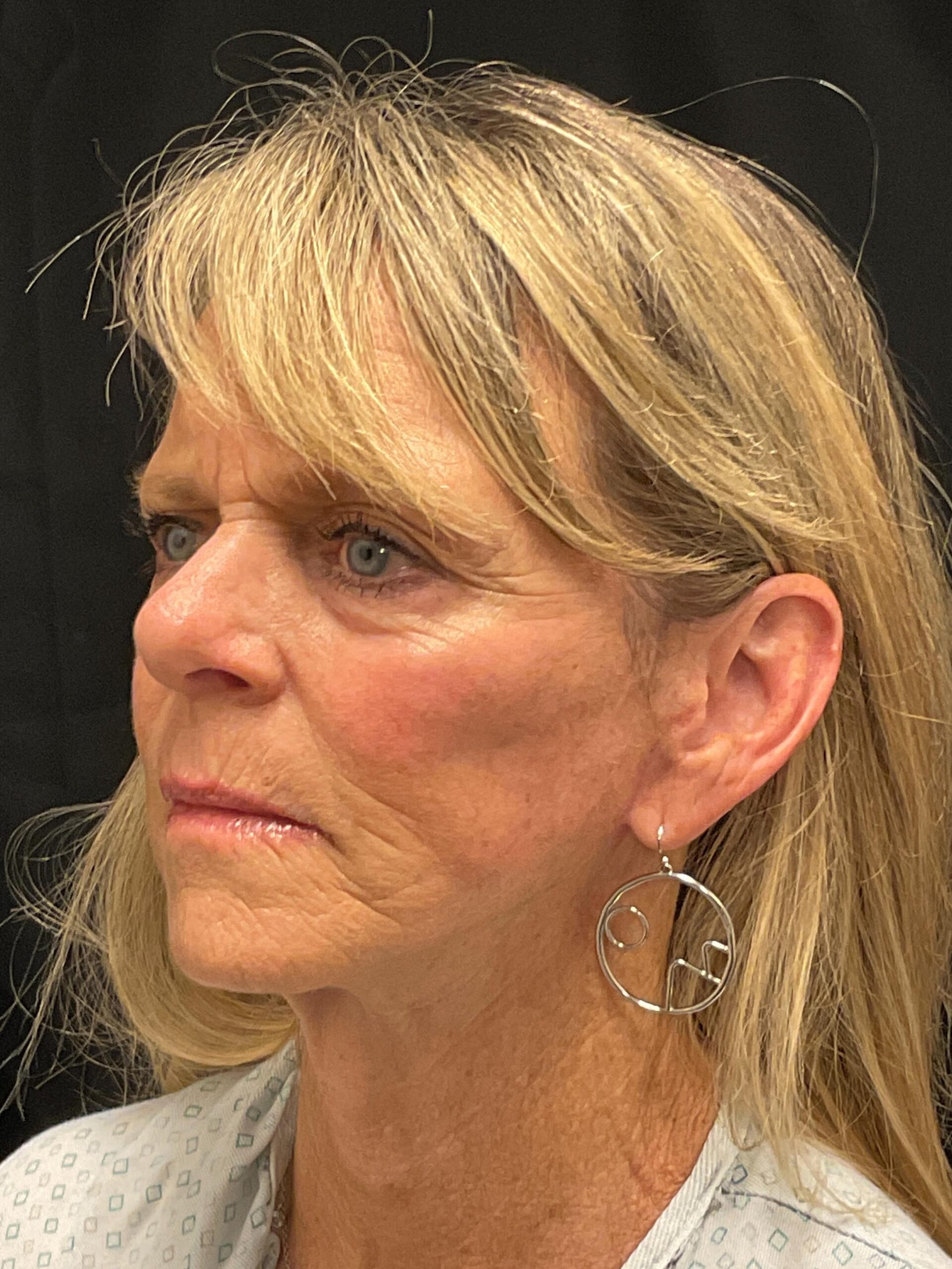 A result from Snyder Plastic Surgery