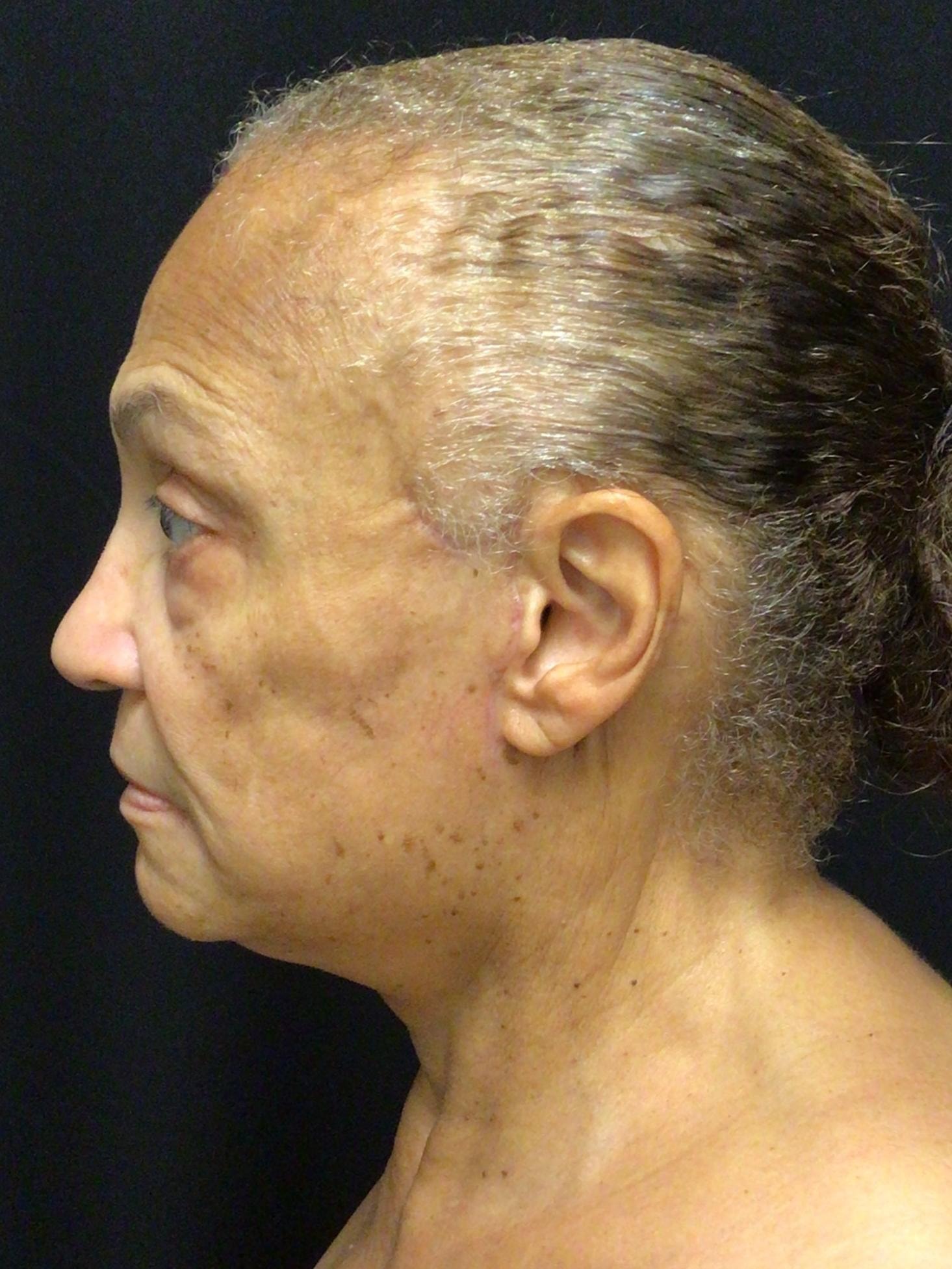 A result from Snyder Plastic Surgery