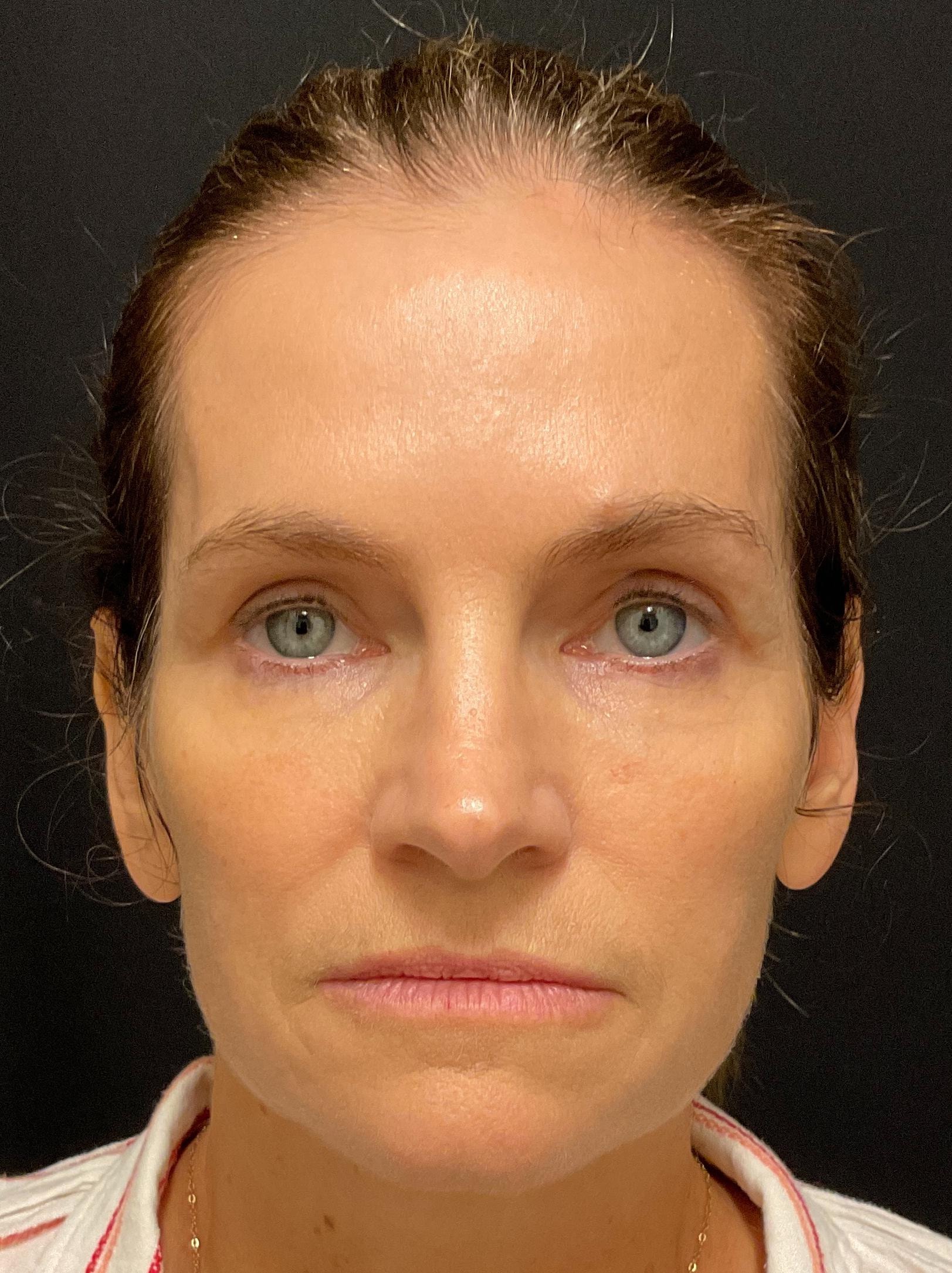 A result from Snyder Plastic Surgery