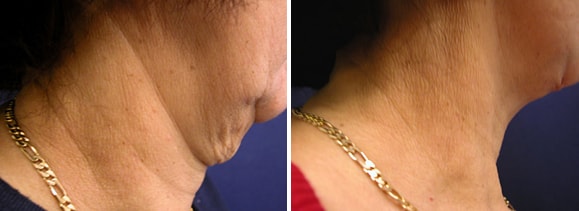 A result from Speron Plastic Surgery