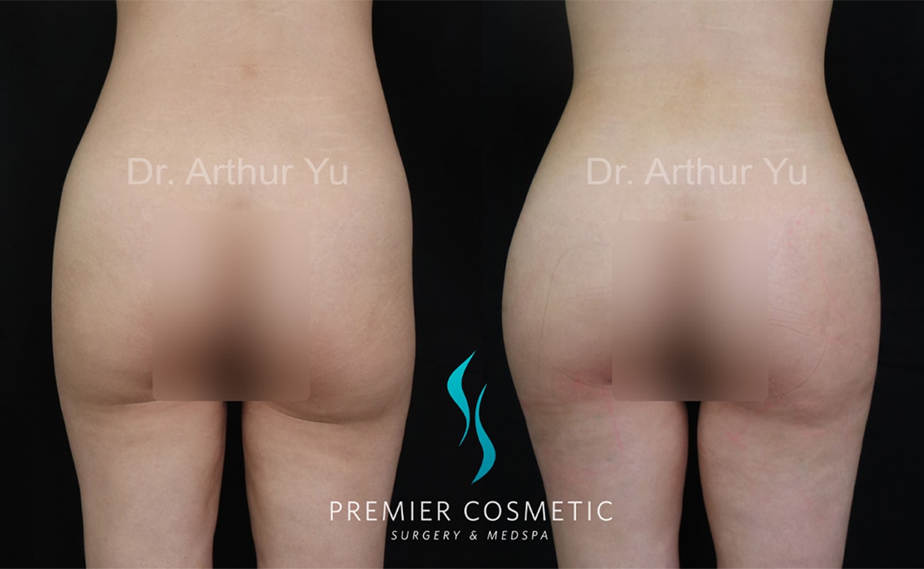 A result from Premier Cosmetic Surgery & Med Spa