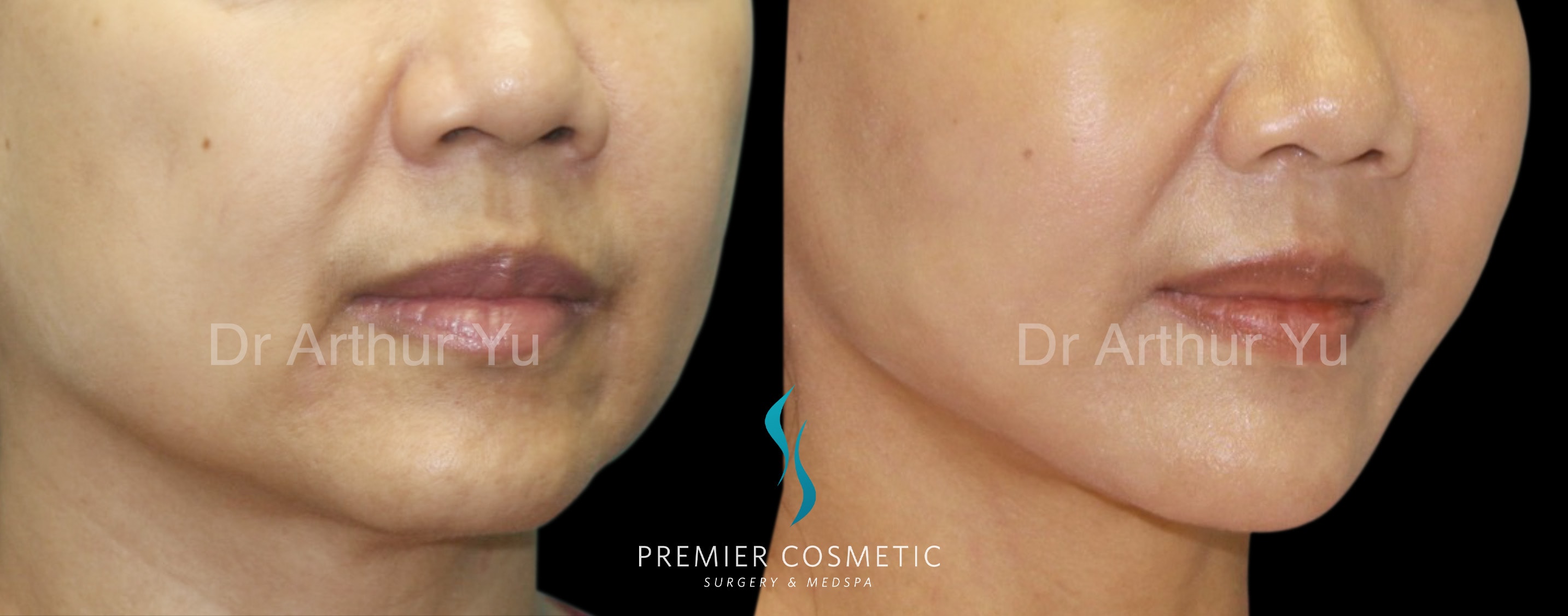 A result from Premier Cosmetic Surgery & Med Spa
