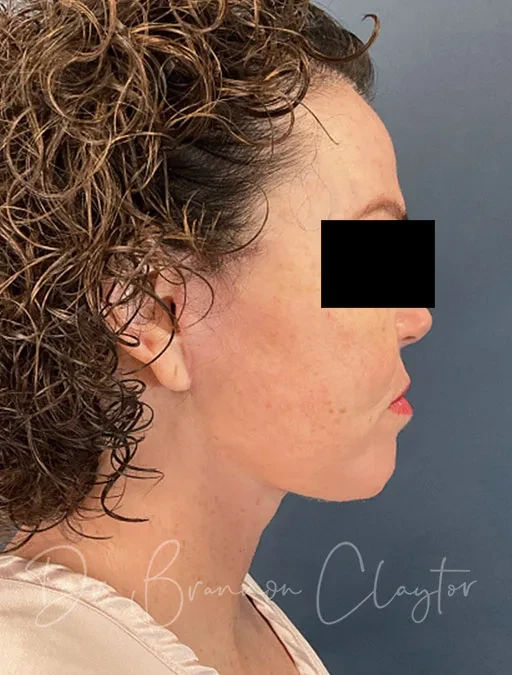 A result from Claytor Noone Plastic Surgery: Dr. R. Brannon Claytor