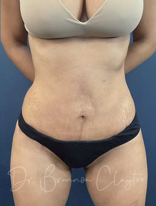 A result from Claytor Noone Plastic Surgery: Dr. R. Brannon Claytor