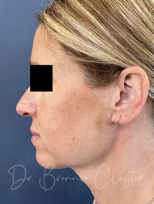 A result from Claytor Noone Plastic Surgery: Dr. R. Brannon Claytor