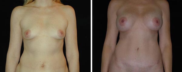 A result from Mezrow Plastic Surgery (Craig Mezrow, MD)