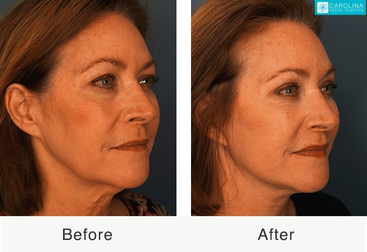 A result from Carolina Facial Plastics