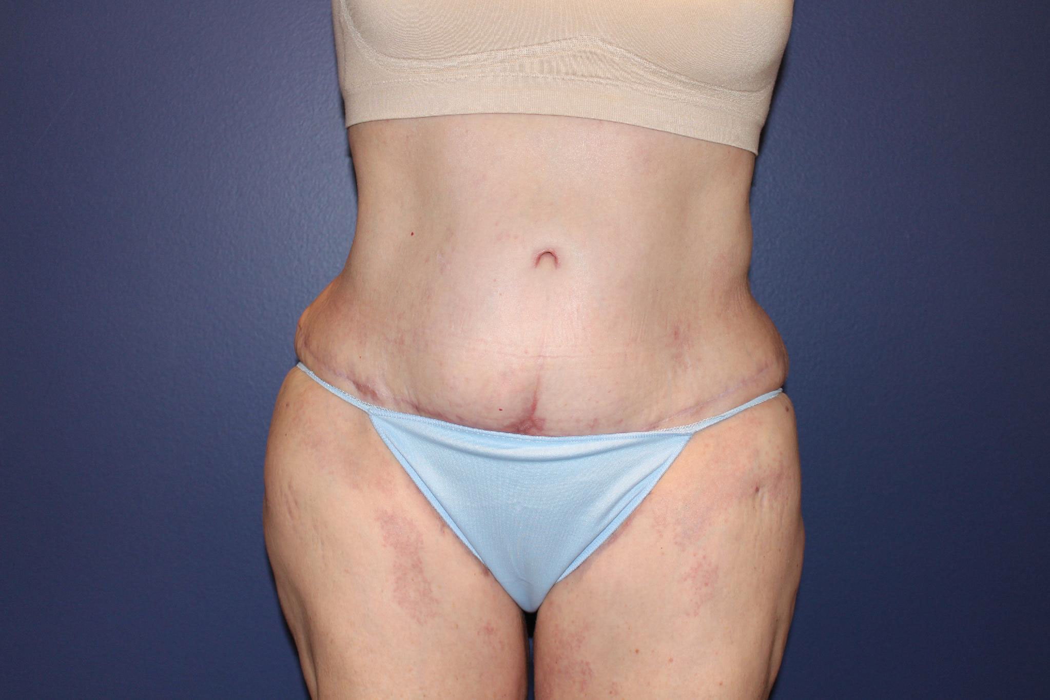 A result from PHASE Plastic Surgery