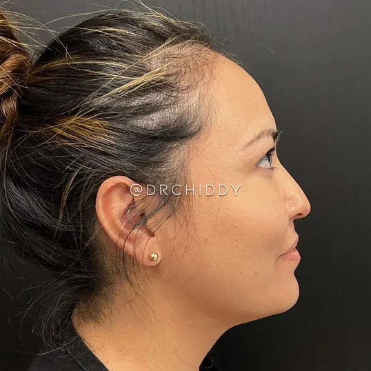 Buccal Fat result at Jerry Chidester MD