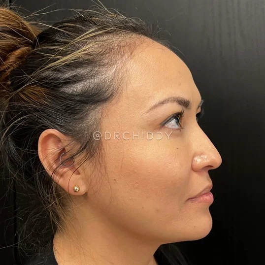 Buccal Fat before photo