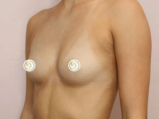 Breast Augmentation before photo