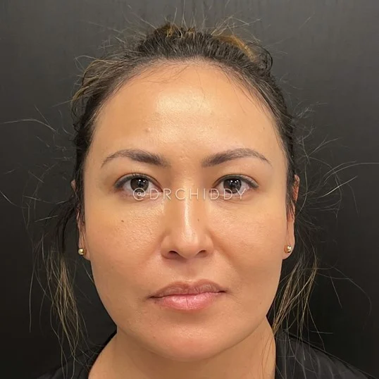 Buccal Fat result at Jerry Chidester MD