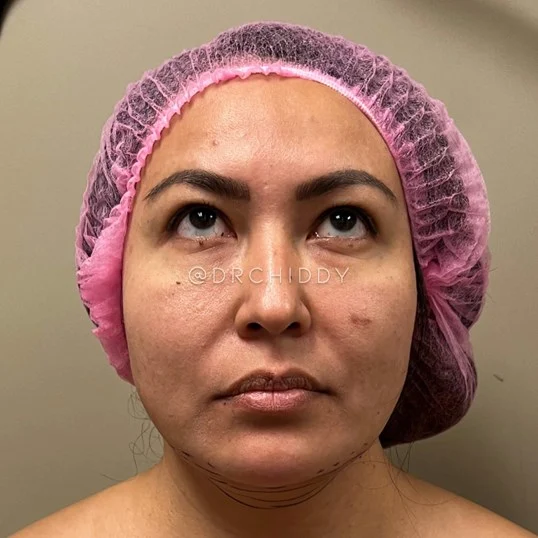 Buccal Fat before photo