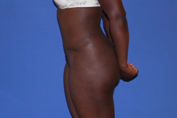 A result from Dr. Joseph Michaels - Plastic Surgeon Rockville
