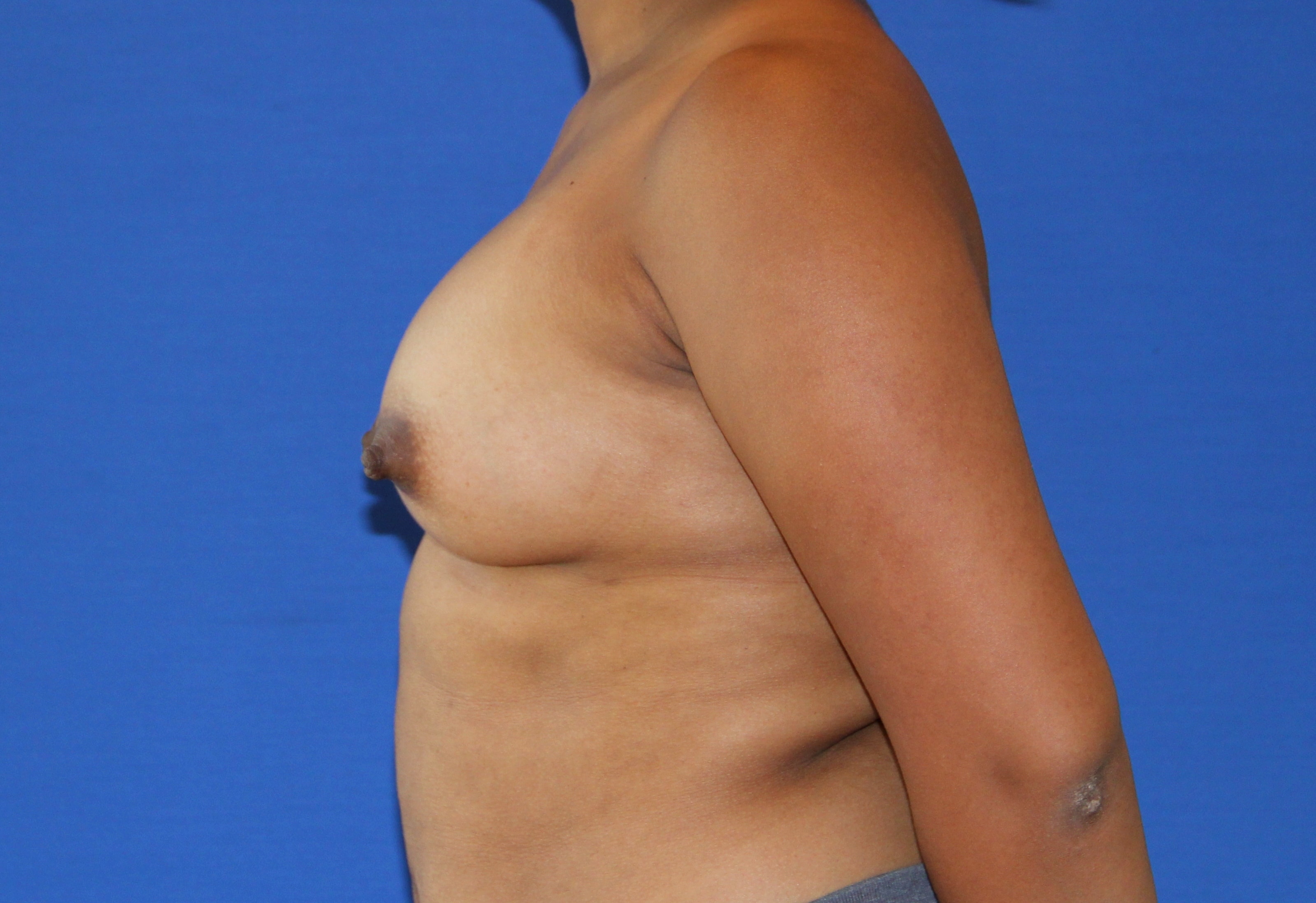 A result from Dr. Joseph Michaels - Plastic Surgeon Rockville