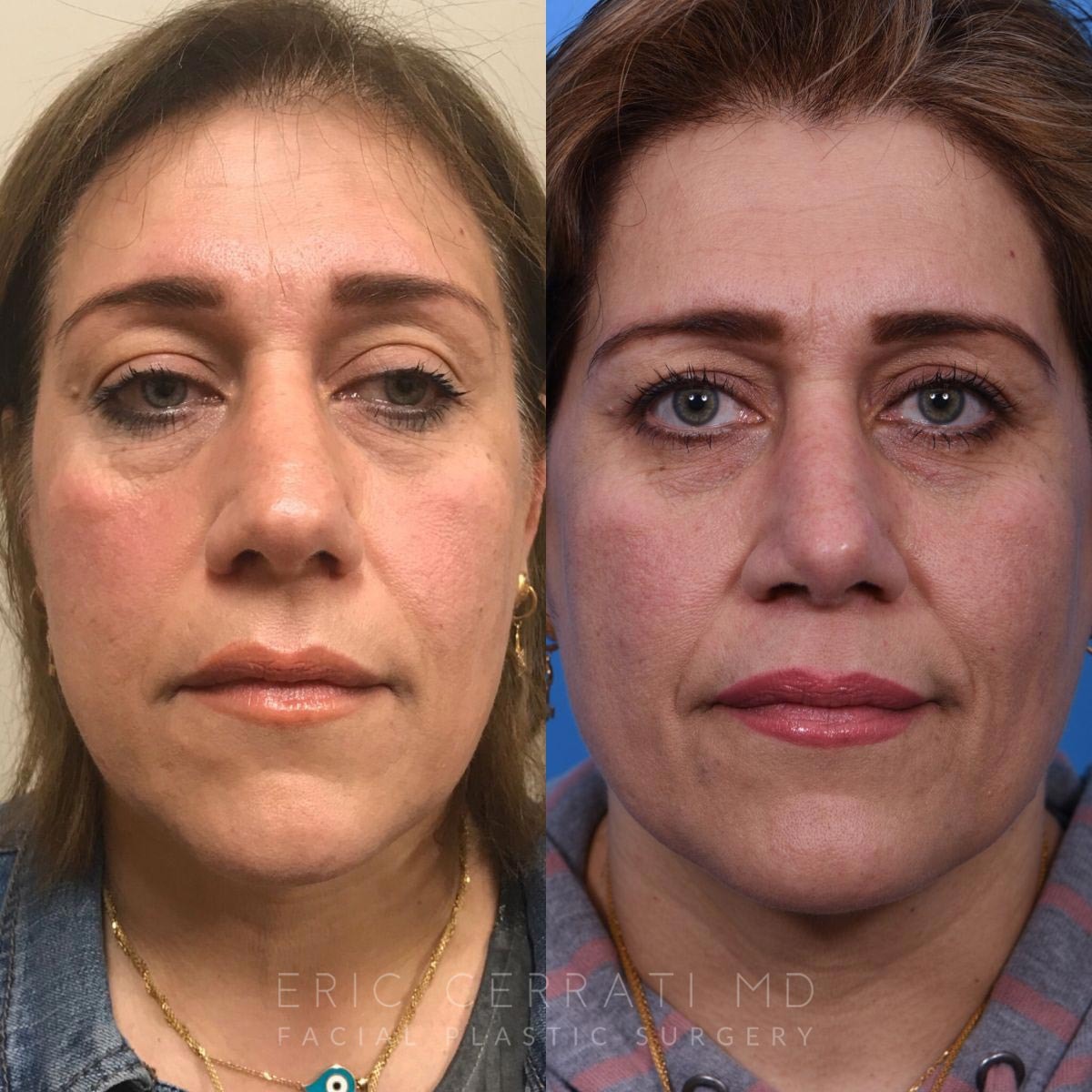 A result from Eric W. Cerrati, MD, FACS