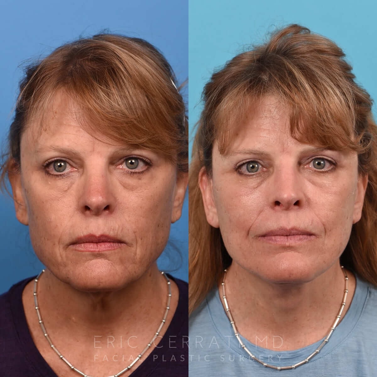 A result from Eric W. Cerrati, MD, FACS