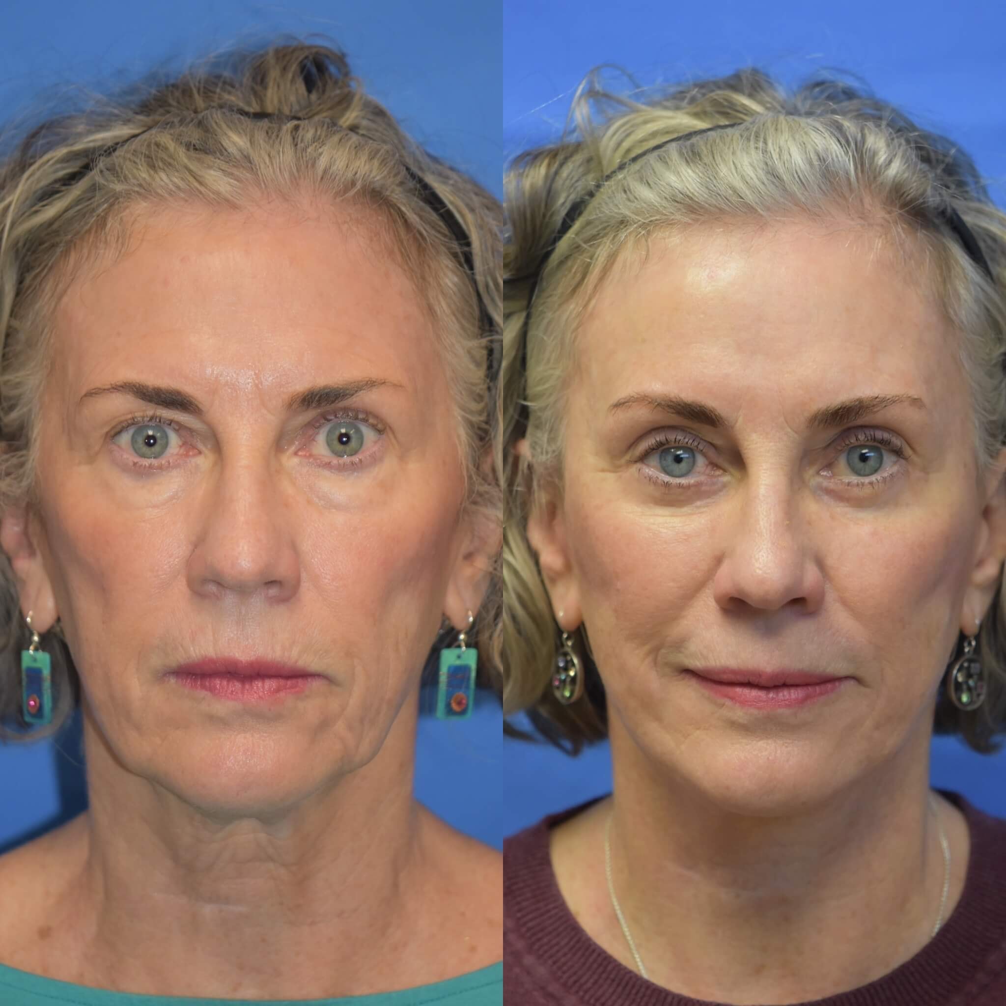 A result from Eric W. Cerrati, MD, FACS