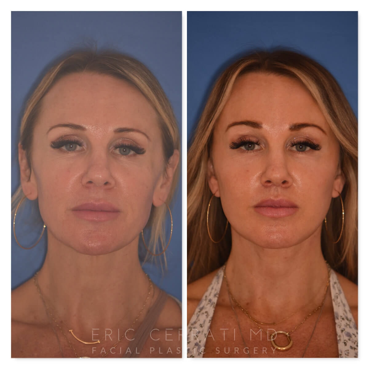 A result from Eric W. Cerrati, MD, FACS