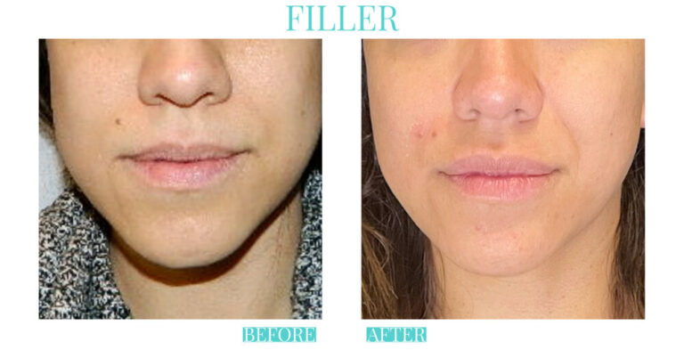 A result from Bliss Medical Spa