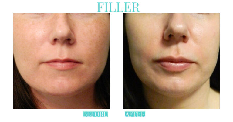 A result from Bliss Medical Spa