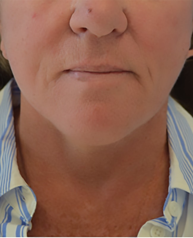 A result from Clareo Plastic Surgery