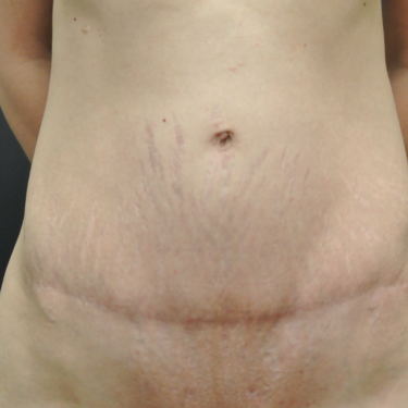 June S. Chen, M.D., P.C. tummy tuck after — Salt Lake City, UT