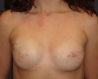 June S. Chen, M.D., P.C. breast augmentation result