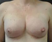 June S. Chen, M.D., P.C. breast augmentation after — Salt Lake City, UT