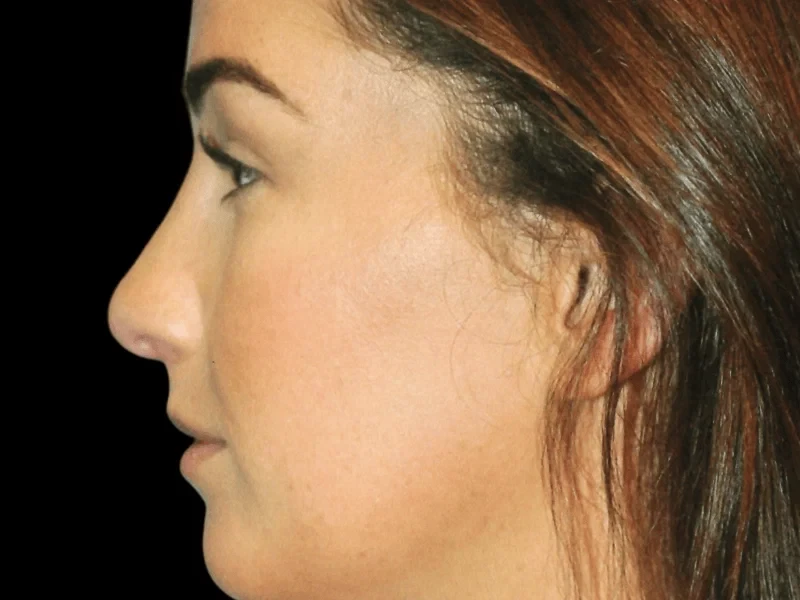 A result from Aesthetic Surgery Center: Michael R. Macdonald, M.D.