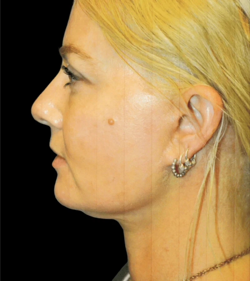 A result from Aesthetic Surgery Center: Michael R. Macdonald, M.D.