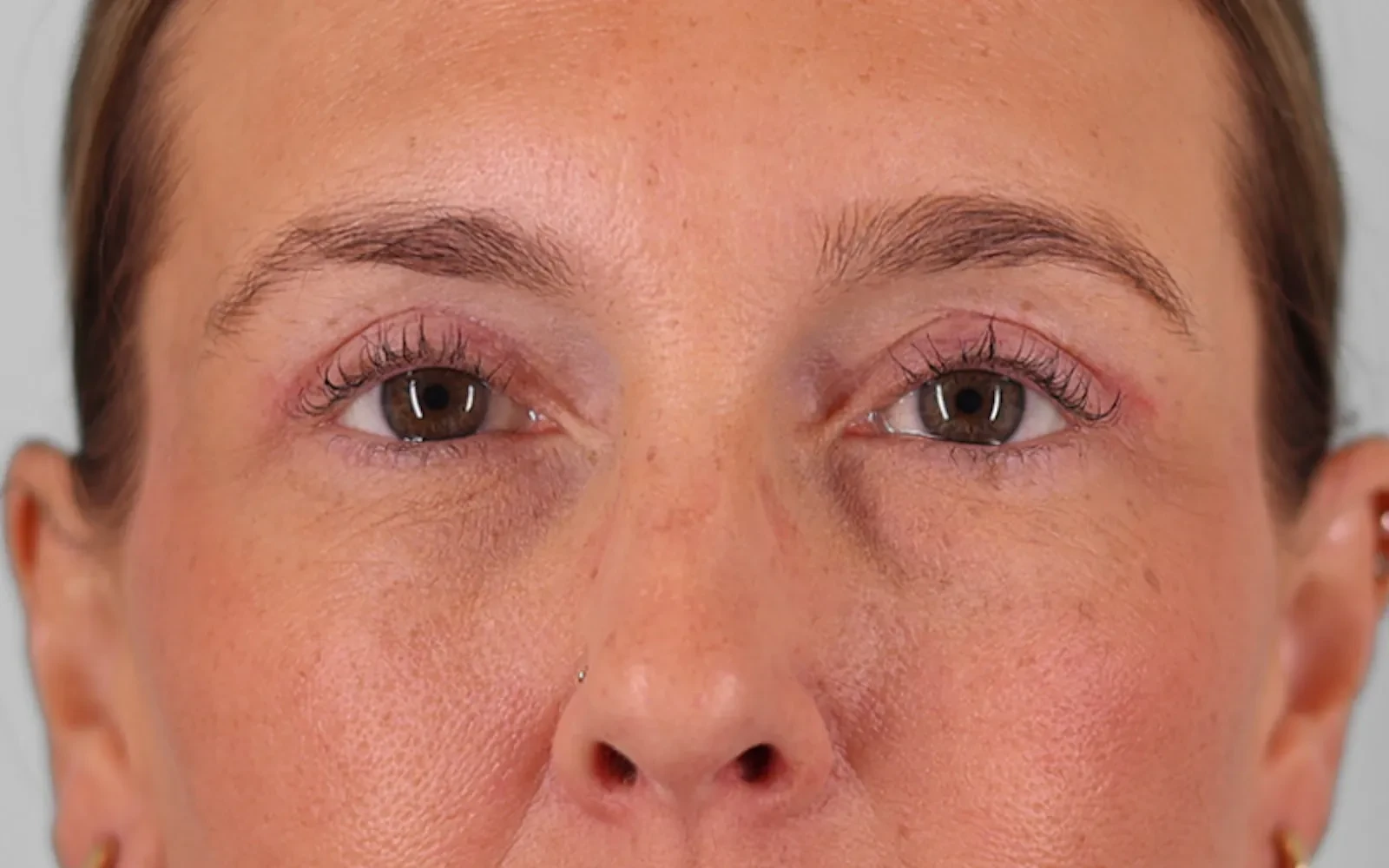 A result from Bay Hills Plastic Surgery