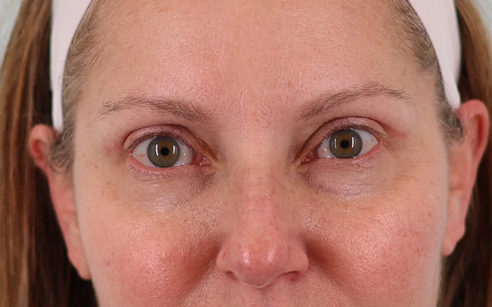 A result from Bay Hills Plastic Surgery