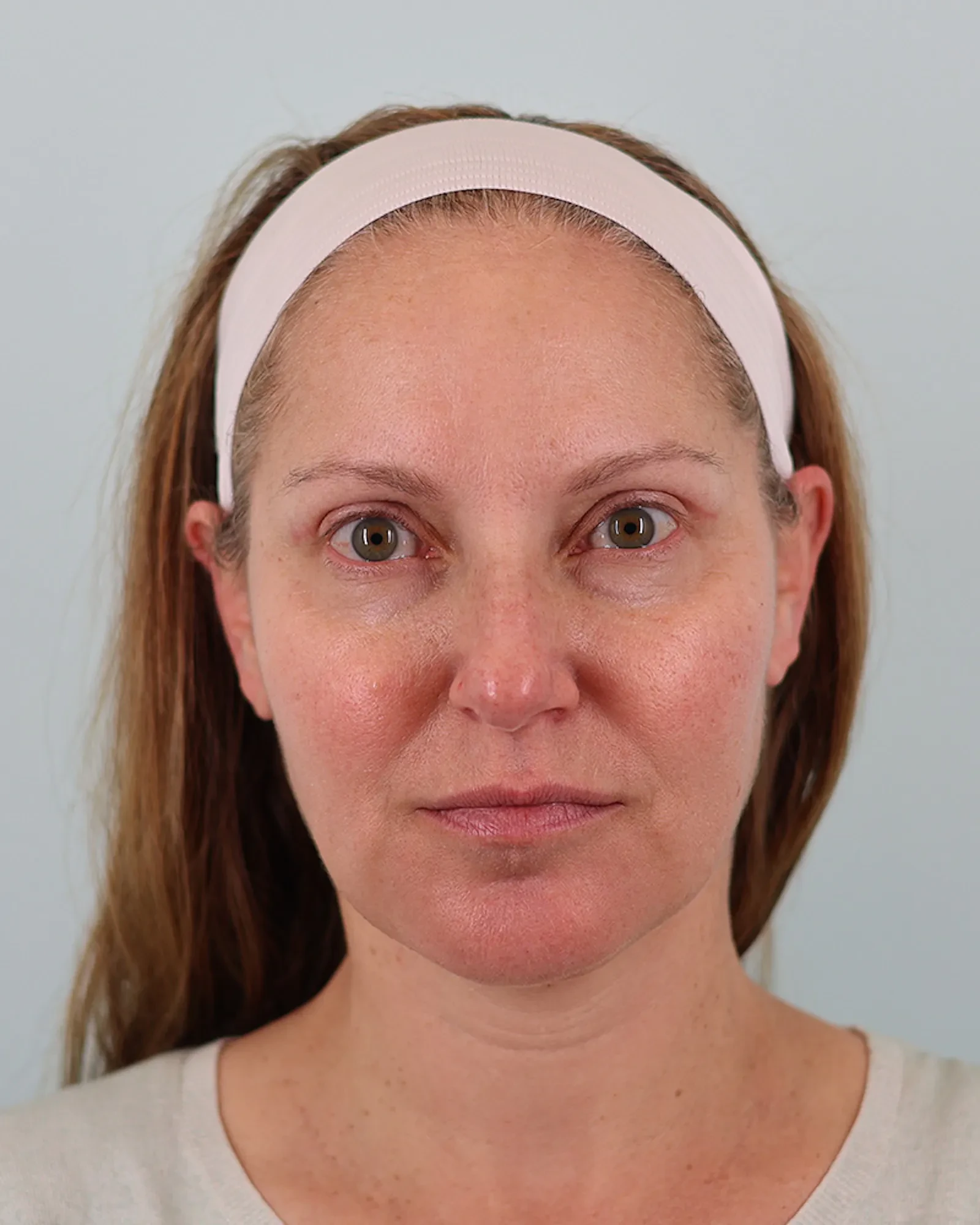 A result from Bay Hills Plastic Surgery