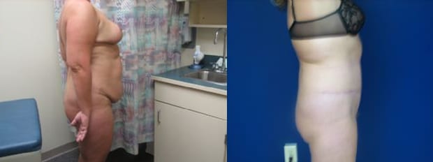 A result from Westfield Plastic Surgery Center